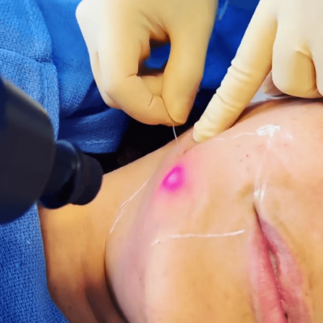 Close-up of Endolift laser treatment being performed on the cheek at Cibibe Beauty & Health.